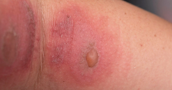 xử trí vết côn trùng đốt