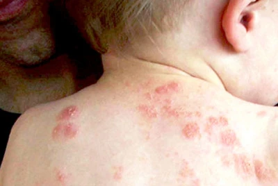 xử trí vết côn trùng đốt